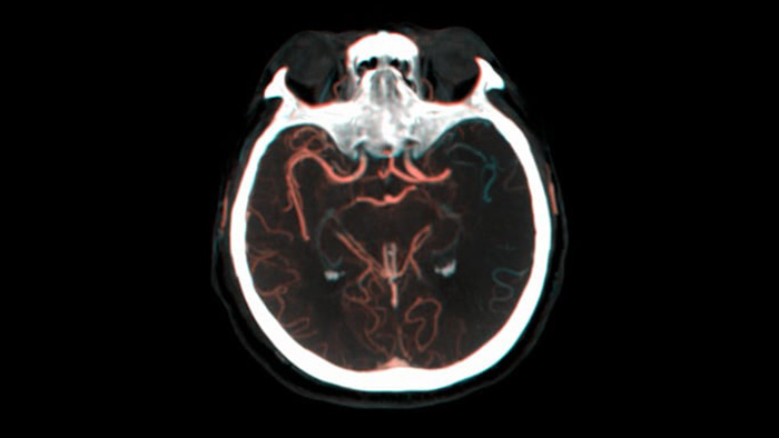Visualizaci&oacute;n de la repleci&oacute;n colateral